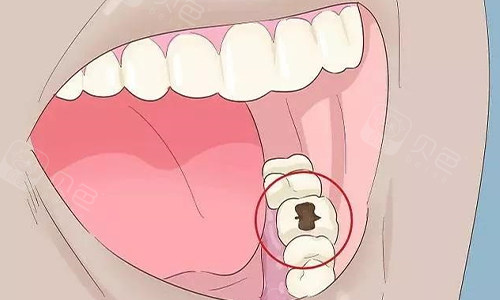 牙齿坏了