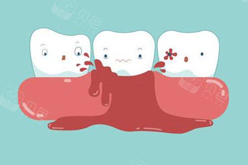 牙齿出血示意图