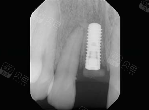 瑞士士卓曼iti种植牙植入后