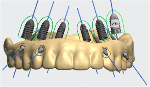 导板种植模拟图