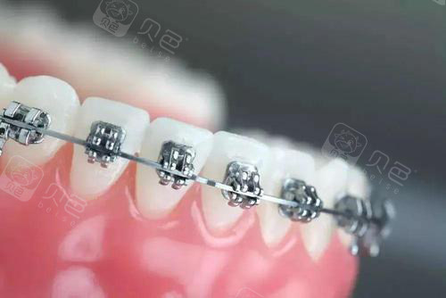 牙齿矫正牙套金属托槽矫正