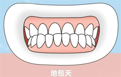地包天卡通示意图