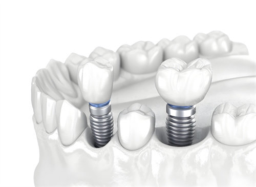 从“缺牙”到“完整”:我的种植牙蜕变之旅,重拾自信微笑