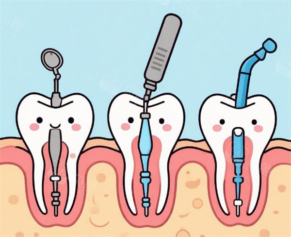 牙齿根管治疗卡通图展示