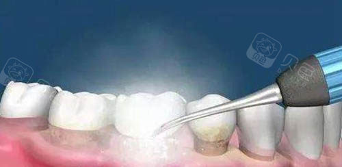 六盘水洗牙技术哪家好？这份推荐名单都是当地洗牙技术超棒的牙科医院！