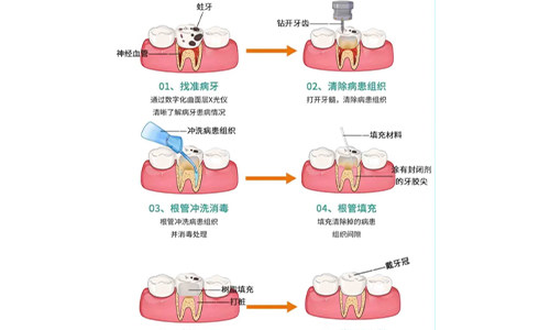 根管治疗的全过程示意图