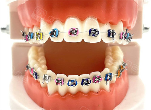 金属托槽矫正模型图片