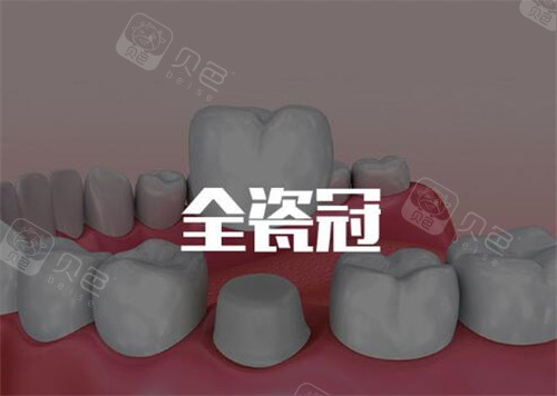 爱尔创全瓷牙能用几年？可用10-20年，材质坚固耐磨使用寿命长久