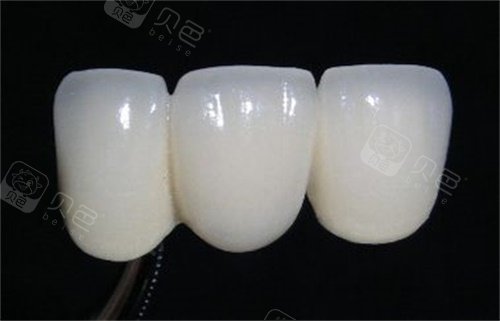 爱尔创有几个档次？瓷倍健、玉瓷、经典等档次，适配不同修复需求