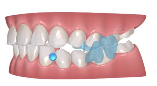 正雅牙套不同版什么差别？经典/GS/航天版适配病例、材质、价格全对比