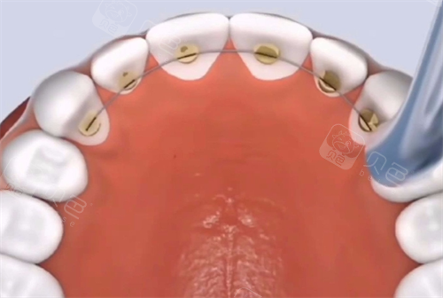 舌侧矫正动画模拟