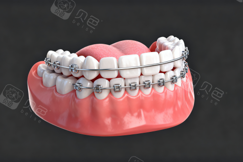 传统自锁矫正器展示图