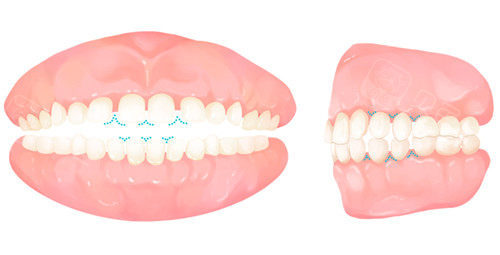 补过牙可以带牙套矫正吗？牙齿稳固即可做，不影响矫正结果