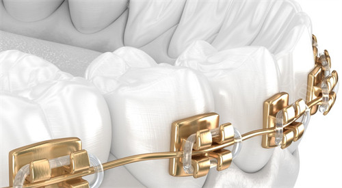 补过牙可以带牙套矫正吗？牙齿稳固即可做，不影响矫正结果