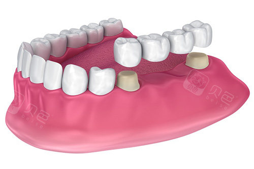 爱尔创全瓷牙800元是坑吗？活动价800元起，平常1000~1200元