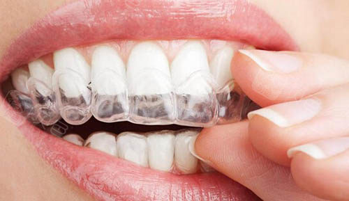 正雅Smartee隐形矫治器适合哪些人群？覆盖不同年龄段需求