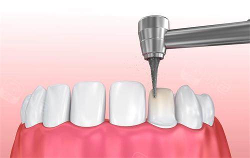 路桥区牙齿美白多少钱一次？亚非/雅汇/三角陈口腔较新价目表及结果对比!