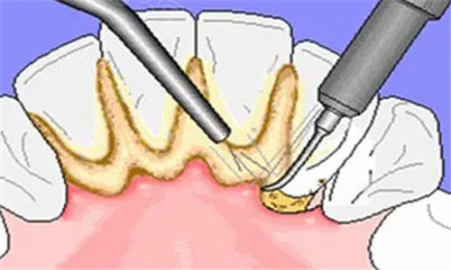 路桥区牙齿美白多少钱一次？亚非/雅汇/三角陈口腔较新价目表及结果对比!