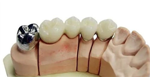 烤瓷牙5年后真实经历:牙龈黑线|邻牙龋坏|崩瓷疼痛全体验