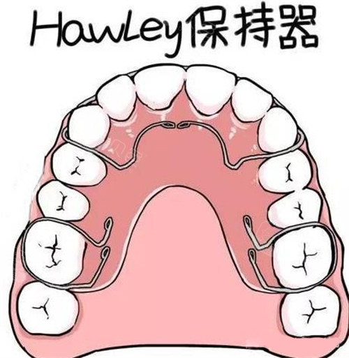 牙齿矫正Hawley哈雷保持器