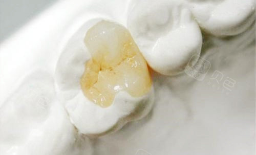 日本可乐丽对比美国3M补牙哪个好？深度解析粘结强度、色泽稳定性及价格