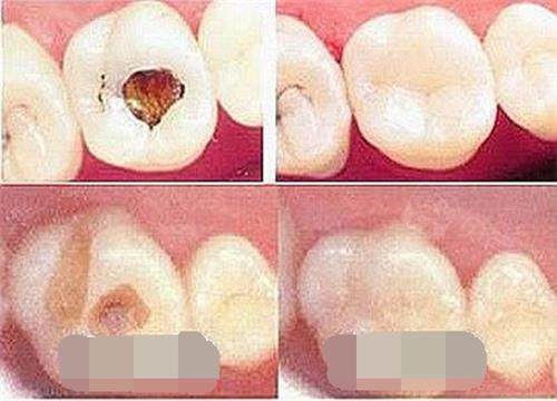 2026进口补牙树脂品牌排行：解析美国3M、德国VOCO义获嘉哪个好用