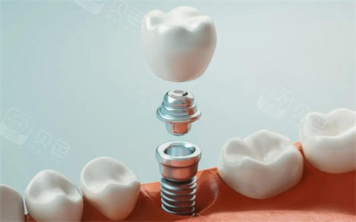 中幸口腔官网牙科收费价目表:种植牙3000元起、牙齿矫正10000元起