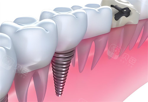 中幸口腔官网牙科收费价目表:种植牙3000元起、牙齿矫正10000元起