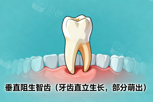 垂直阻生智齿展示