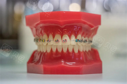 牙齿矫正宣传展示