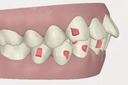 北京英博京植口腔看牙便宜吗？种牙2980起，来看更多正畸修牙价格不贵