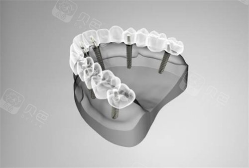 北京英博京植口腔看牙便宜吗？种牙2980起，来看更多正畸修牙价格不贵