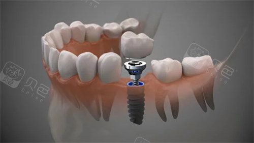 佳木斯大学附属口腔价格高吗？正规收费公开：种牙2980+矫正8000+