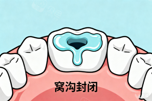 牙齿窝沟封闭展示图