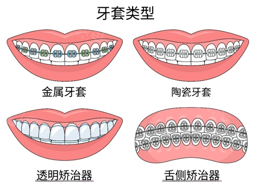 牙齿矫正常见方式