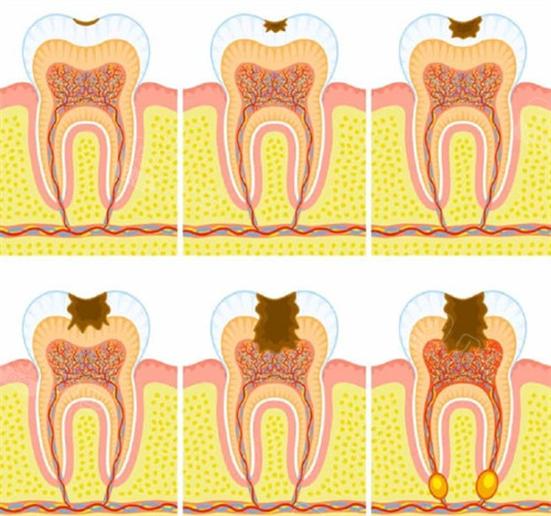 需要根管治疗的牙齿