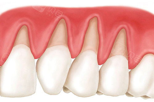 口腔种植手术包怎么打乌兰察布牙科机构收费标准2026：含种植牙、洗牙及补牙本地行情价一览_https://www.jmylbn.com_新闻资讯_第2张