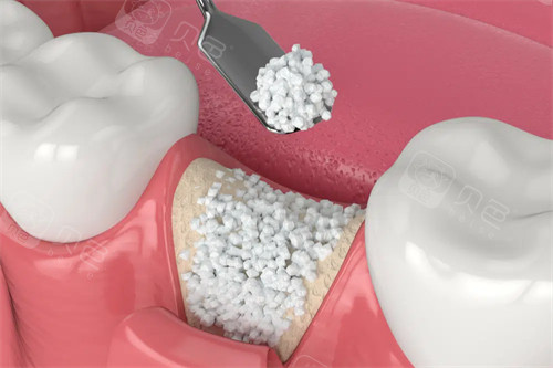 牙槽骨骨粉植入漫画图