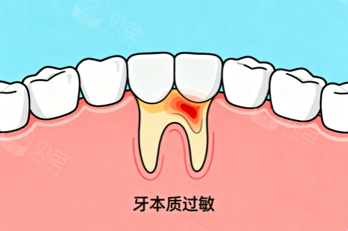 牙本质过敏卡通图