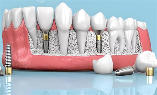 种植牙材料动画展示