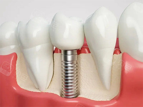 种植牙模型解刨图