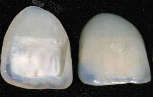 牙齿贴面成品