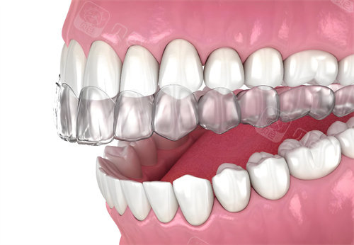 2026芜湖隐形矫正大概需要准备多少钱？对比时代天使与隐适美全新报价