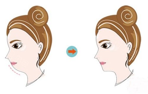 正畸和正颌手术加起来一共多少钱？详细拆解费用构成与省钱建议