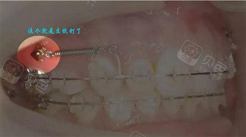 正畸正颌手术风险大吗？牙科医生详解真实风险与规避方法，看完再决定！