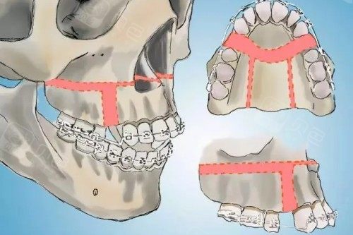 正畸手术和正颌手术的区别是什么?傻傻分不清?选错可能白花钱!看完就懂了
