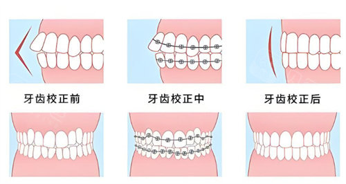 牙齿矫正前后对比图