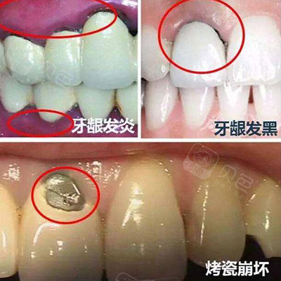 烤瓷牙冠修复缺点