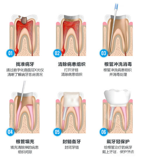 根管治疗流程示意图