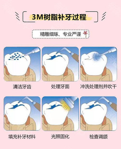 3M树脂补牙过程